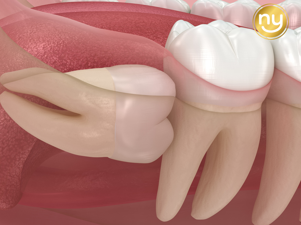 울산안아픈치과