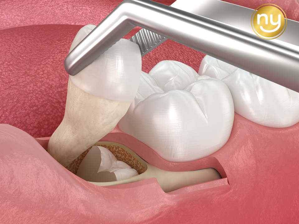 울산안아픈치과